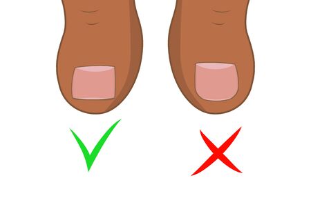 Right to cut toenails. Ingrown toe nail. Pedicure foot sole vector illustration.のイラスト素材