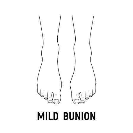 Hallux valgus, mild bunion. Vector illustration. Orthopedics foot illnessのイラスト素材