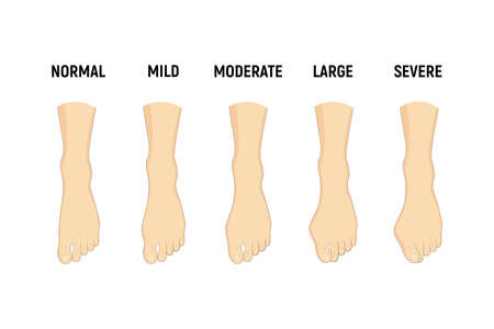 Hallux valgus disease stages, normal, mild, moderate, large, severe Vector illustration Orthopedics foot illnessのイラスト素材