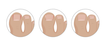 Medical illustration showing three steps of ingrown toenail healing process after tamponade surgery, from inflammation to healthy nailのイラスト素材