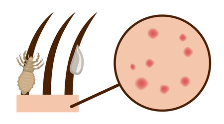 Medical illustration showing a head louse clinging to hairs, a nit attached to a hair and a zoomed area of skin with red spots caused by louse bitesのイラスト素材