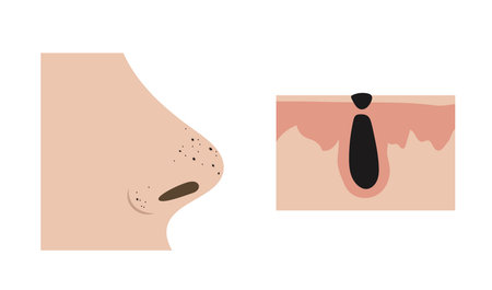 Blackheads clogging pores on nose and anatomical detail of comedo formationのイラスト素材