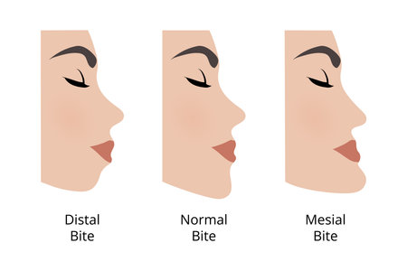 Medical illustration showing three different types of dental occlusion, comparing distal bite, normal bite and mesial bite, useful for explaining underbite and overbite problemsのイラスト素材