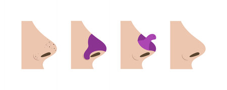 Four step process showing how to remove blackheads from nose using a purple cosmetic pore strip, starting with blackheads on nose and ending with clean noseのイラスト素材
