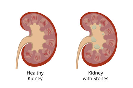 Healthy kidney compared to kidney with kidney stones forming insideのイラスト素材