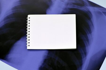 X-Ray film image of human chest for a medical diagnosis and empty blank notepad page on blue hospital table. Flat lay top view composition with copy spaceの写真素材