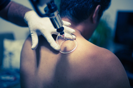 Acupuncture therapist placing cups on the back of male patientの写真素材