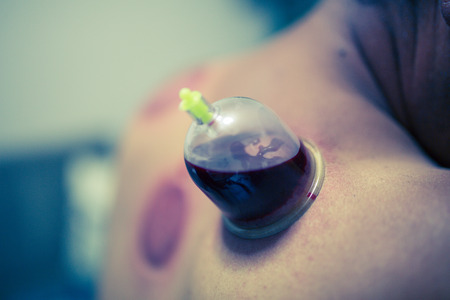 Acupuncture therapist placing cup on the back of male patient