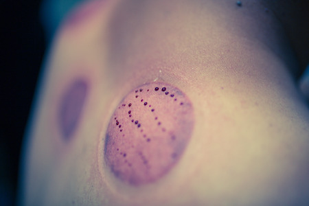 Acupuncture therapist placing cup on the back of male patientの写真素材