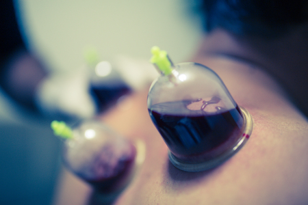 Acupuncture therapist placing cup on the back of male patientの写真素材