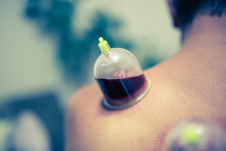 Acupuncture therapist placing cup on the back of male patientの写真素材