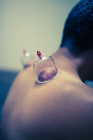 Acupuncture therapist placing cup on the back of male patientの写真素材