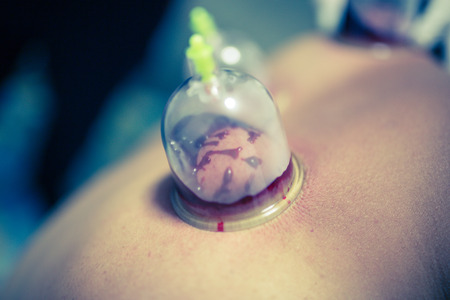 Acupuncture therapist placing cup on the back of male patientの写真素材