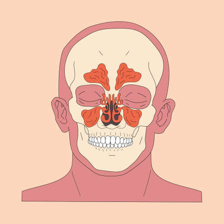 Sinusitis, rhinosinusitis vector illustrationのイラスト素材