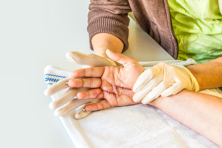 hand physiotherapy to recover a broken finderの写真素材