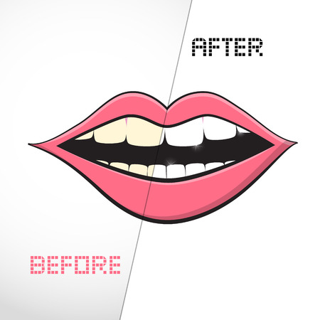 Vector Mouth on White Background. Cleaning Teeth, Before and After.のイラスト素材