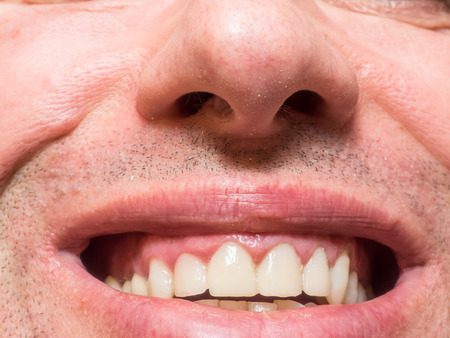 Four upper front teeth after crown installationの写真素材