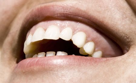 Close up on white teethの写真素材