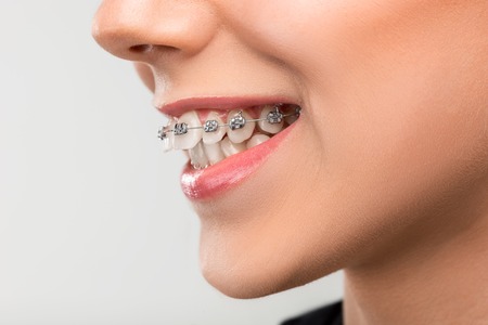 Beautiful young woman with teeth braces