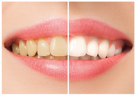 The female teeth before and after whitening.の写真素材