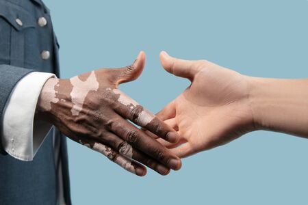 Close up of male hands with vitiligo pigments isolated on blue studio background. Wearing office attire, workwear. Special skin. Greeting somebody. Business, finance, advertising concept. Copyspace.の写真素材