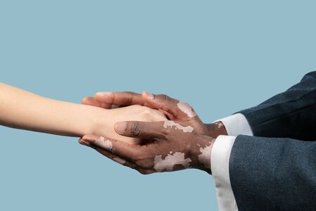 Close up of male hands with vitiligo pigments isolated on blue studio background. Wearing office...