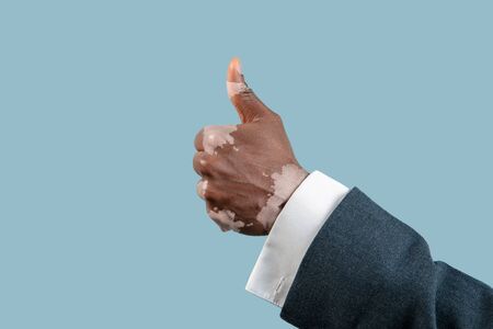 Close up of male hands with vitiligo pigments isolated on blue studio background. Wearing office...
