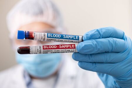 View of a doctor holding a fictional test tube blood sample, infected with virus.の写真素材