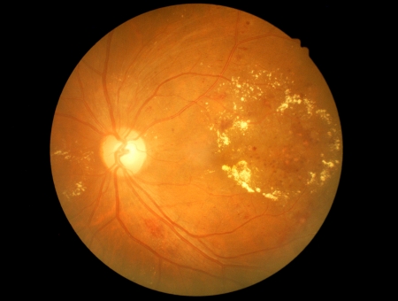 Medical photo of retinal pathology,exudates,micro aneurysmsの写真素材