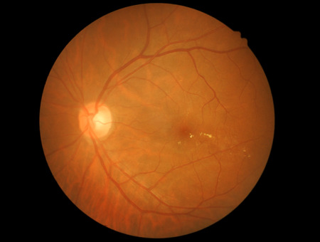Medical photo retinal of diabeticの写真素材