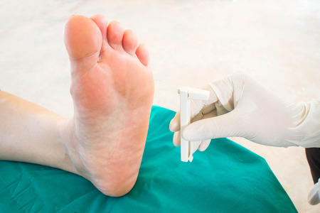 diabetic foot skining  neuropathyの写真素材