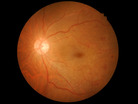 Retina of diabetic - diabetic retinophatyの写真素材