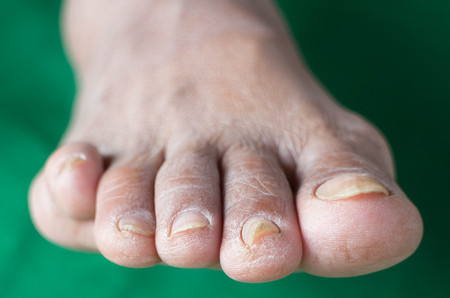 Complications of diabetes , Dermatophyteの写真素材