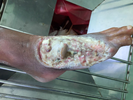wound of diabetic footの写真素材