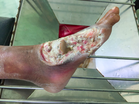 wound of diabetic footの写真素材
