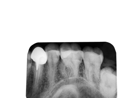 Closeup of a dental x-ray