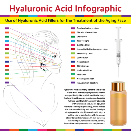 Hyaluronic Asid Infographic. Plastic Surgery of the Face. 
Facial Contouring. Methods of Rejuvenation. Plastic Surgery. Vector Illustration. Face Points for the Administration of Botox Injectionsのイラスト素材
