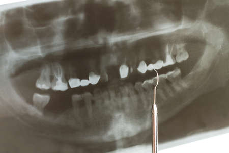A dental radiography of an unhealthy mouth with broken teethの写真素材