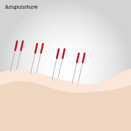 Getting acupuncture treatment. Vector illustration.のイラスト素材