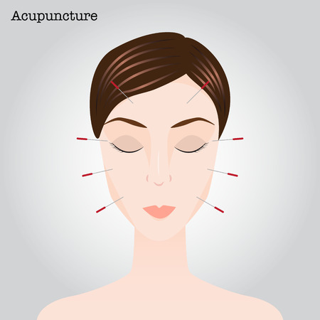 Woman getting an acupuncture treatment. Vector illustrationのイラスト素材