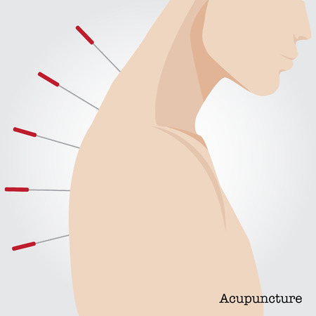 Getting acupuncture treatment. Vector illustration.のイラスト素材