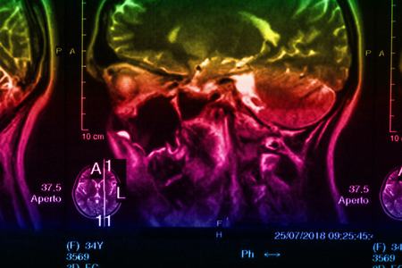 The X-ray of the human brain closeup imageの写真素材