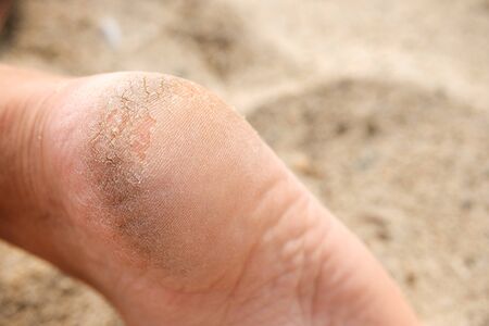 foot with damaged skin on the heel, cracks and hard parts of the skin. legs requiring a visit to a...