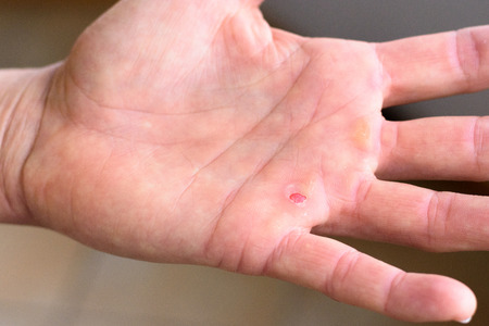 Close up on a persons hand with blisters and calluses on the palm from manual workの写真素材