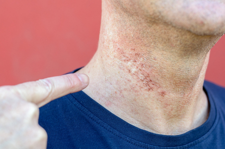 Skin irritation after cosmetic surgery close-up on mans neck