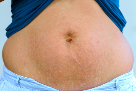 Woman displaying stretch marks on her abdomen after pregnancy caused by tearing of the dermis layer...
