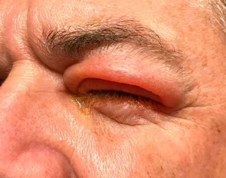Sie view of the badly swollen upper eyelid of a man with his eye with pus and a thick discharge oozing through his closed eyelidsの写真素材