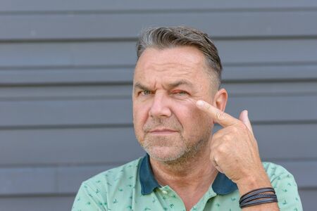 Man pointing to an inflamed eye caused by a bacterial infection, stye or hordeolum of the upper eyelid with purulent discharge and conjunctivitisの写真素材