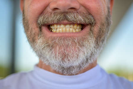 Close up on the teeth and chin of a senior bearded man as he gives the camera a toothy grin showing gold fillings in a dental conceptの写真素材