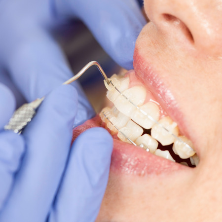 Orthodontist working with invisible ceramic braces. Close-upの写真素材